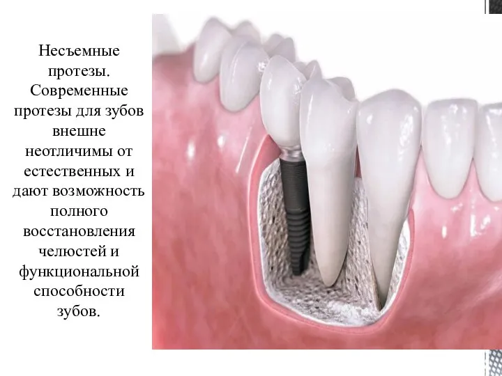 Несъемные протезы. Современные протезы для зубов внешне неотличимы от естественных и дают