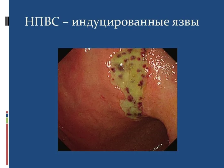 НПВС – индуцированные язвы