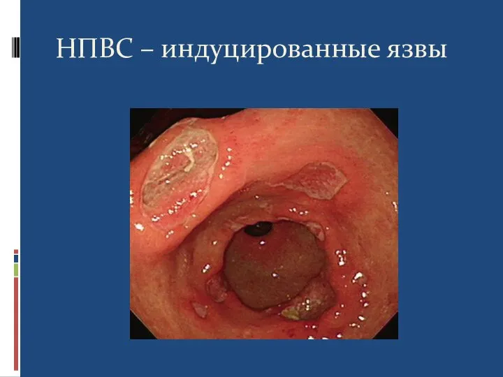 НПВС – индуцированные язвы