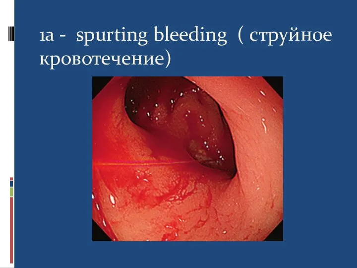 1a - spurting bleeding ( струйное кровотечение)