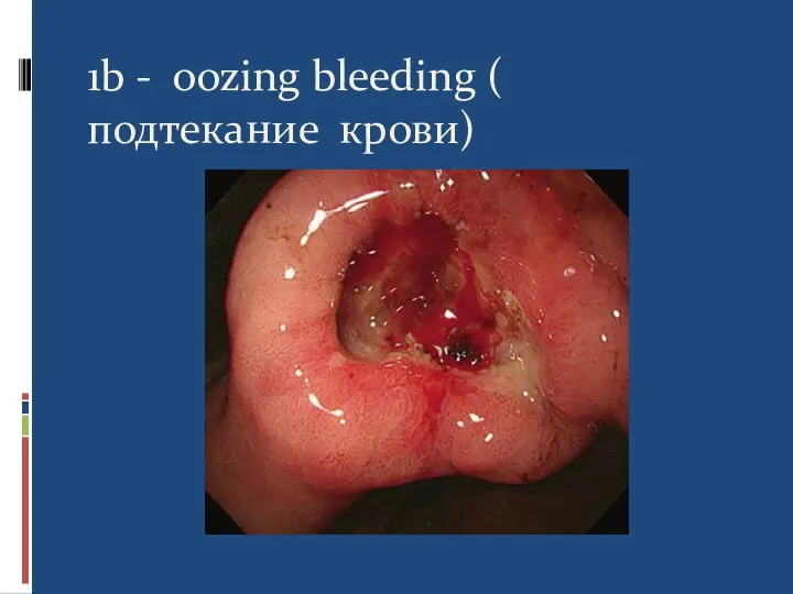 1b - oozing bleeding ( подтекание крови)