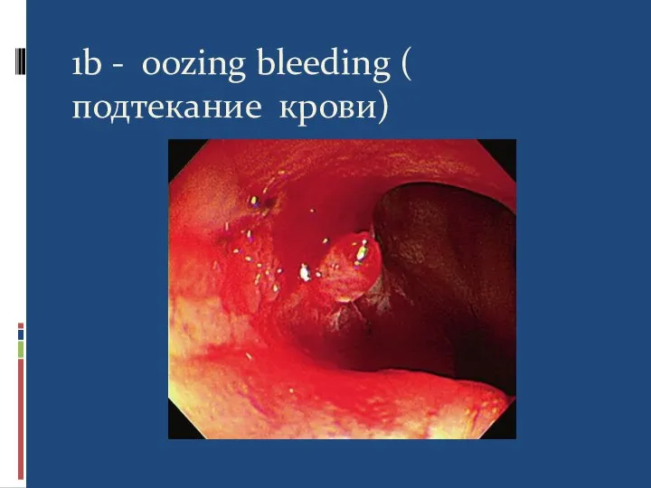 1b - oozing bleeding ( подтекание крови)