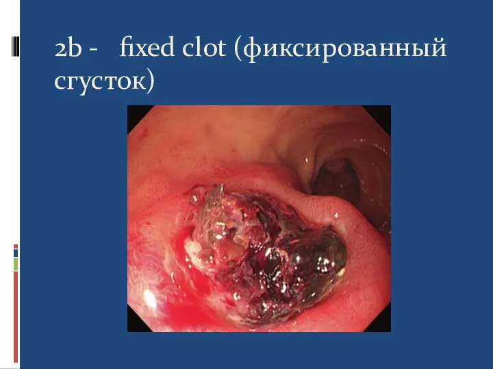 2b - fixed clot (фиксированный сгусток)