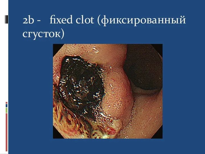 2b - fixed clot (фиксированный сгусток)