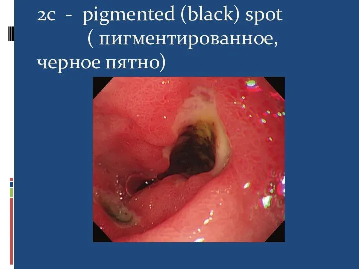 2c - pigmented (black) spot ( пигментированное, черное пятно)