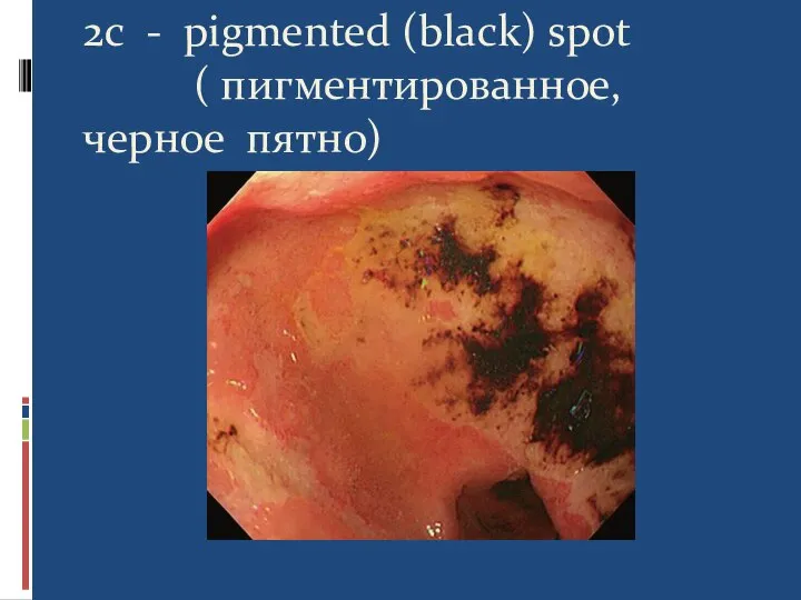 2c - pigmented (black) spot ( пигментированное, черное пятно)