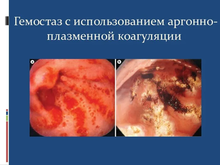 Гемостаз с использованием аргонно-плазменной коагуляции