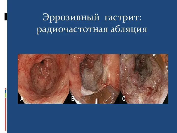 Эррозивный гастрит: радиочастотная абляция