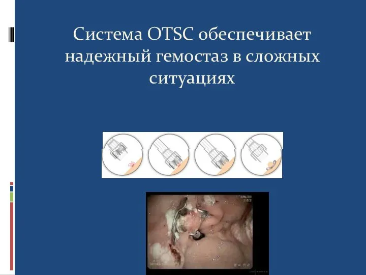 Система OTSC обеспечивает надежный гемостаз в сложных ситуациях