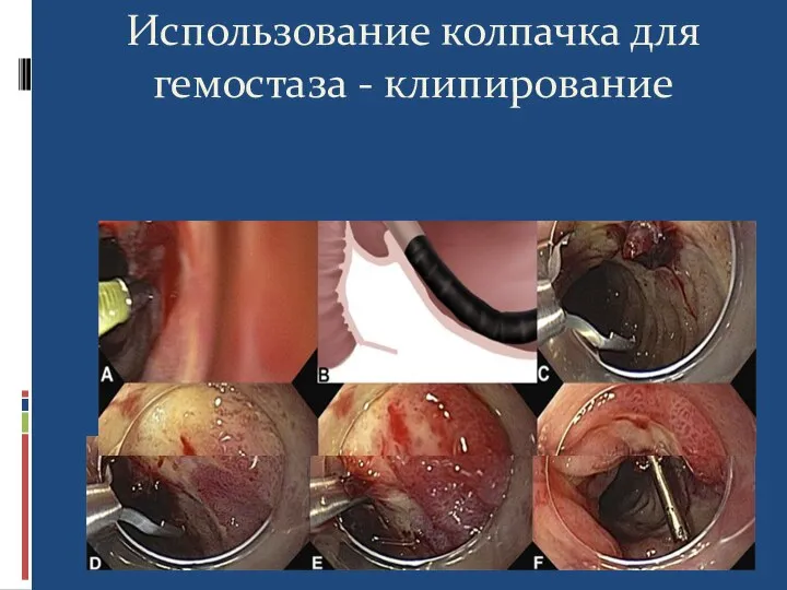 Использование колпачка для гемостаза - клипирование