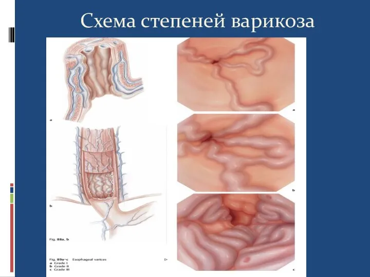 Схема степеней варикоза