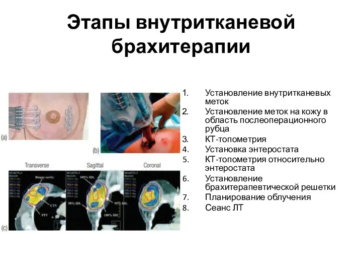 Этапы внутритканевой брахитерапии Установление внутритканевых меток Установление меток на кожу в область