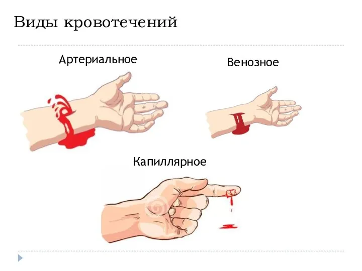 Виды кровотечений Артериальное Венозное Капиллярное