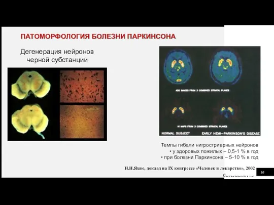 ПАТОМОРФОЛОГИЯ БОЛЕЗНИ ПАРКИНСОНА Темпы гибели нигростриарных нейронов у здоровых пожилых – 0,5-1