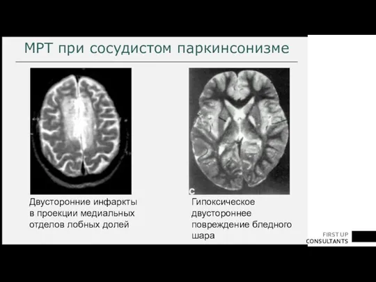 МРТ при сосудистом паркинсонизме Гипоксическое двустороннее повреждение бледного шара Двусторонние инфаркты в