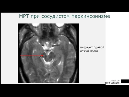 МРТ при сосудистом паркинсонизме инфаркт правой ножки мозга