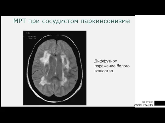 МРТ при сосудистом паркинсонизме Диффузное поражение белого вещества