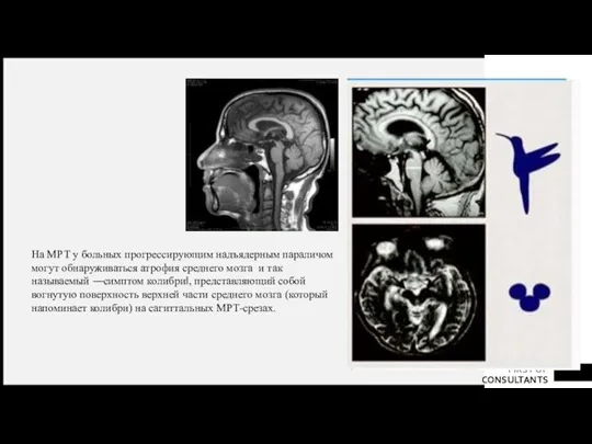 На МРТ у больных прогрессирующим надъядерным параличом могут обнаруживаться атрофия среднего мозга