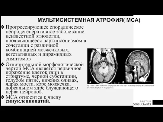 МУЛЬТИСИСТЕМНАЯ АТРОФИЯ( МСА) Прогрессирующее спорадическое нейродегенеративное заболевание неизвестной этиологии, проявляющееся паркинсонизмом в