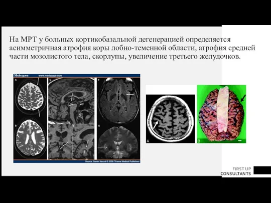 На МРТ у больных кортикобазальной дегенерацией определяется асимметричная атрофия коры лобно-теменной области,