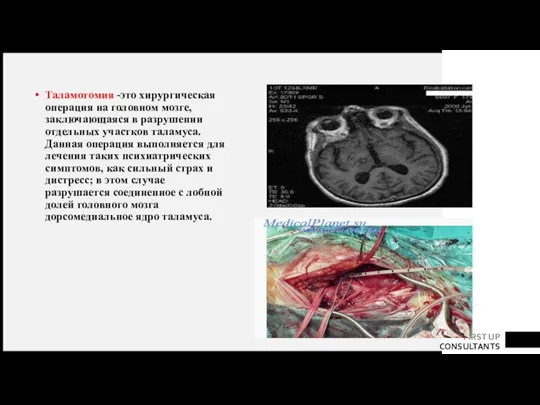 Таламотомия -это хирургическая операция на головном мозге, заключающаяся в разрушении отдельных участков