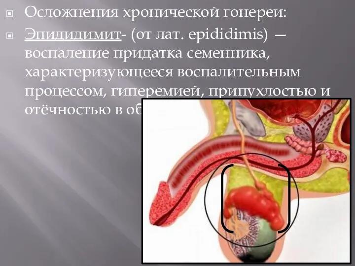 Осложнения хронической гонереи: Эпидидимит- (от лат. epididimis) — воспаление придатка семенника, характеризующееся