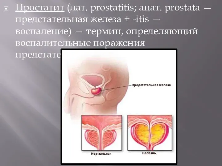 Простатит (лат. prostatitis; анат. prostata — предстательная железа + -itis — воспаление)