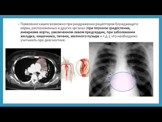 Появление кашля возможно при раздражении рецепторов блуждающего нерва, расположенных в других органах