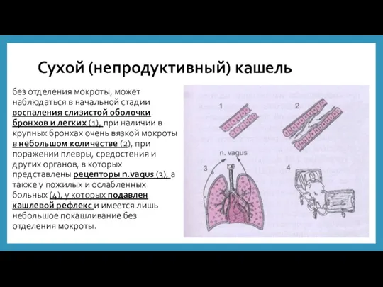 Сухой (непродуктивный) кашель без отделения мокроты, может наблюдаться в начальной стадии воспаления