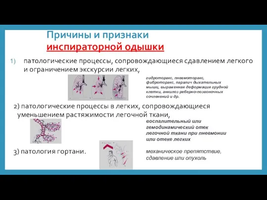 Причины и признаки инспираторной одышки патологические процессы, сопровождающиеся сдавлением легкого и ограничением