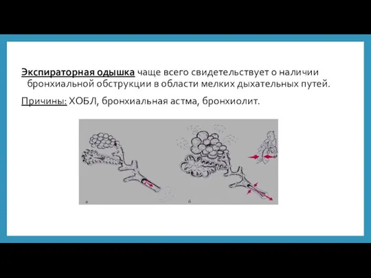 Экспираторная одышка чаще всего свидетельствует о наличии бронхиальной обструкции в области мелких