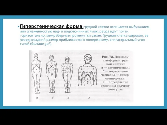 Гиперстеническая форма грудной клетки отличается выбуханием или сглаженностью над- и подключичных ямок,