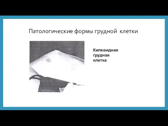 Патологические формы грудной клетки Килевидная грудная клетка