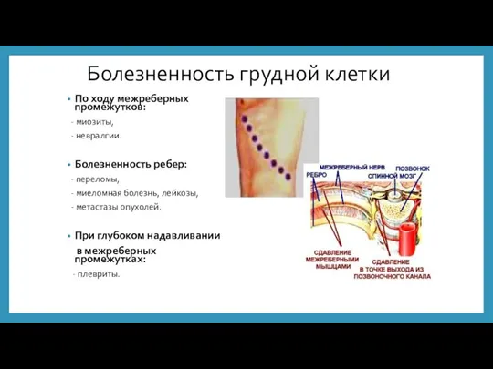 Болезненность грудной клетки По ходу межреберных промежутков: - миозиты, - невралгии. Болезненность