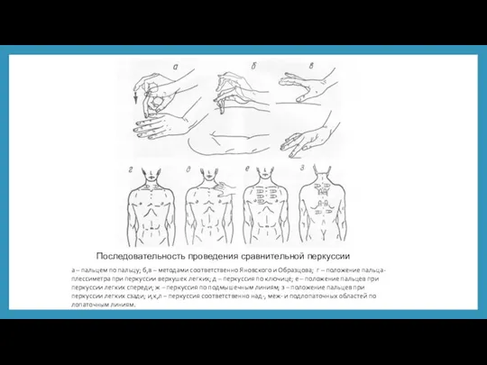 Последовательность проведения сравнительной перкуссии а – пальцем по пальцу; б,в – методами