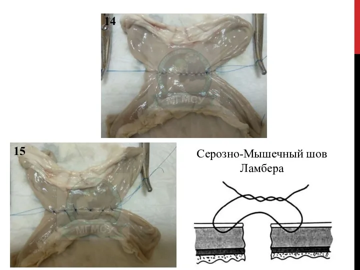 14 15 Серозно-Мышечный шов Ламбера