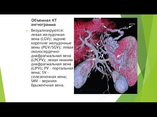 Объемная КТ ангиограмма Визуализируются: левая желудочная вена (LGV); задние короткие желудочные вены