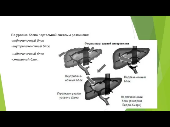 По уровню блока портальной системы различают: -подпеченочный блок -внутрипеченочный блок -надпеченочный блок -смешанный блок.