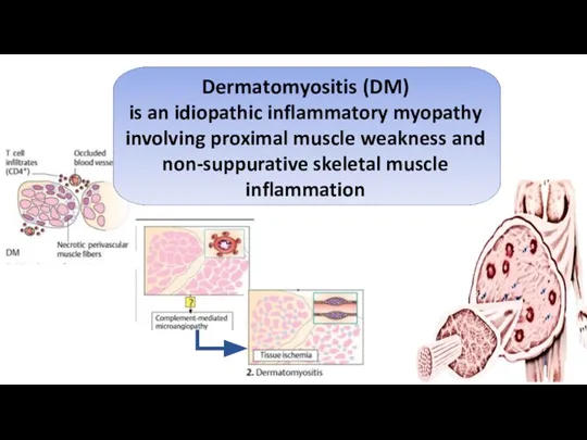 Dermatomyositis (DM) is an idiopathic inflammatory myopathy involving proximal muscle weakness and non-suppurative skeletal muscle inflammation