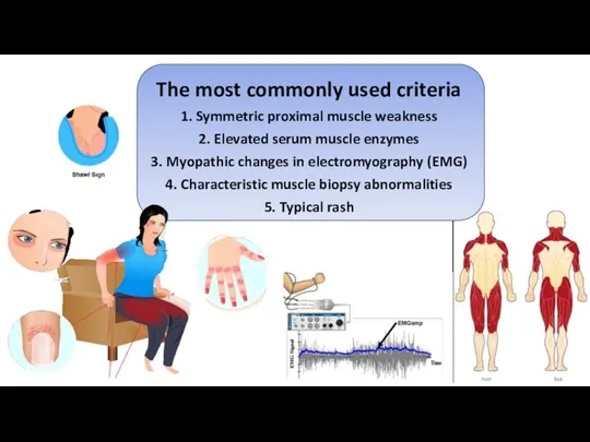 The most commonly used criteria 1. Symmetric proximal muscle weakness 2. Elevated