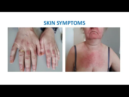 SKIN SYMPTOMS