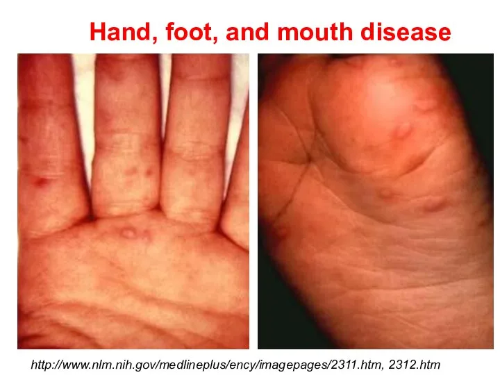 Hand, foot, and mouth disease http://www.nlm.nih.gov/medlineplus/ency/imagepages/2311.htm, 2312.htm