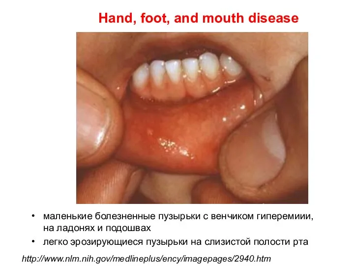 Hand, foot, and mouth disease маленькие болезненные пузырьки с венчиком гиперемиии, на