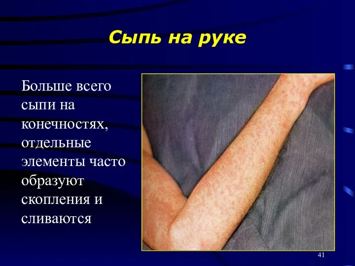 Сыпь на руке Больше всего сыпи на конечностях, отдельные элементы часто образуют скопления и сливаются