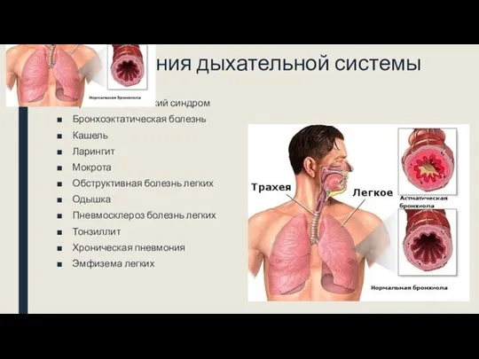 Заболевания дыхательной системы Астма Бронхоспастический синдром Бронхоэктатическая болезнь Кашель Ларингит Мокрота Обструктивная