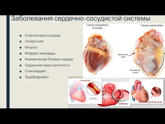 Заболевания сердечно-сосудистой системы Атеросклероз сосудов Гипертония Инсульт Инфаркт миокарда Ишемическая болезнь сердца Сердечная недостаточность Стенокардия Тромбофлибит