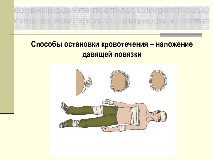 Способы остановки кровотечения – наложение давящей повязки