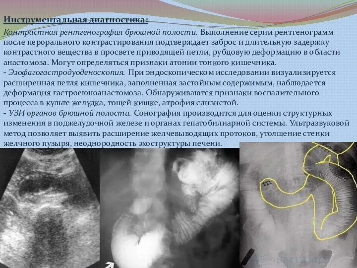 Инструментальная диагностика: Контрастная рентгенография брюшной полости. Выполнение серии рентгенограмм после перорального контрастирования