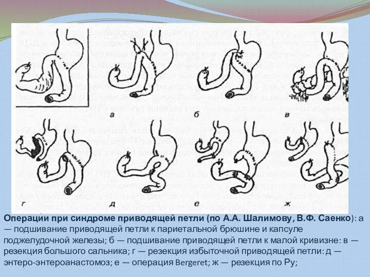 Операции при синдроме приводящей петли (по А.А. Шалимову, В.Ф. Саенко): а —
