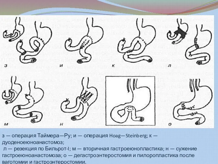 з — операция Таймера—Ру; и — операция Hoag—Steinberg; к — дуоденоеюноанастомоз; л